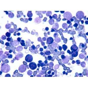  Iron Deficiency Anemia in a Bone Marrow Smear Photographic 