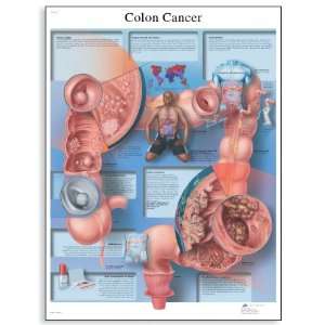 3B Scientific VR1432UU Glossy Paper Colon Cancer Anatomical Chart 